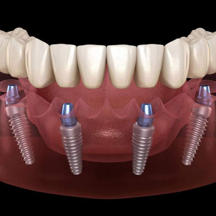 Des implants dentaires tout à fait compatibles avec les prothèses.