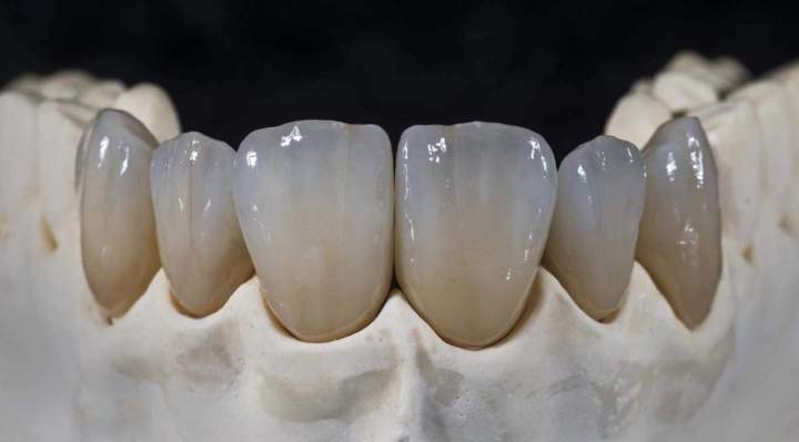 Couronne en disilicate de lithium Montréal