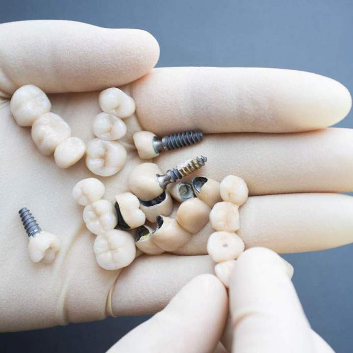 Des prothèses fixes avec un rendu esthétique imitant parfaitement les dents naturelles.